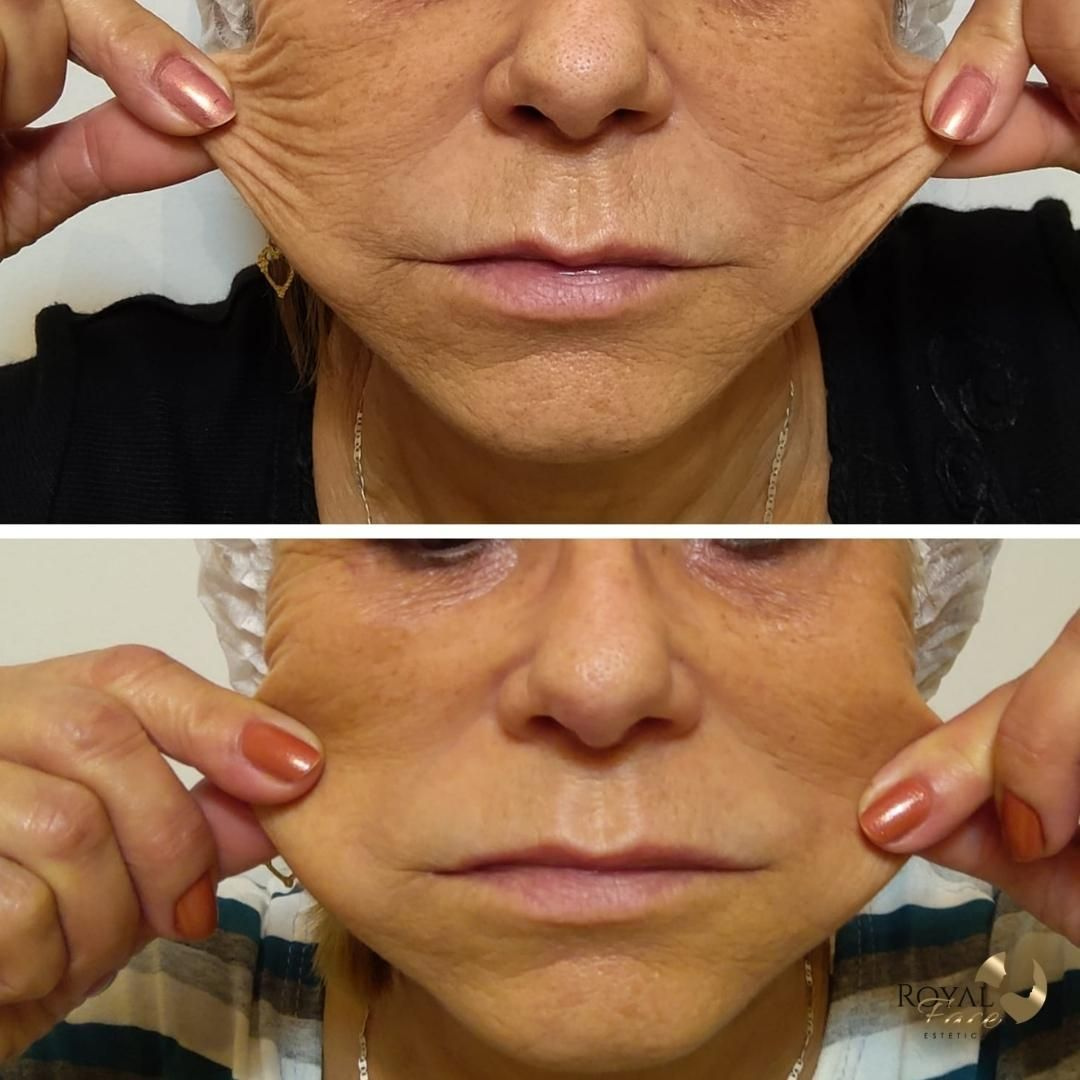 Bioestimuladores de Colágeno