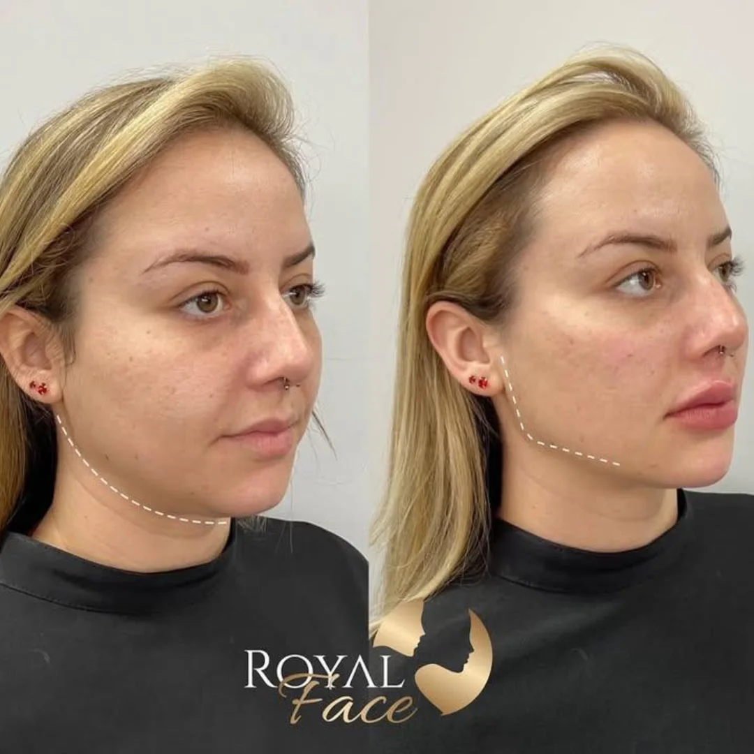 Harmonização Facial